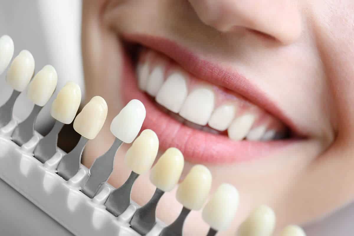 Cómo Funciona el Diseño de Sonrisa: Paso a Paso