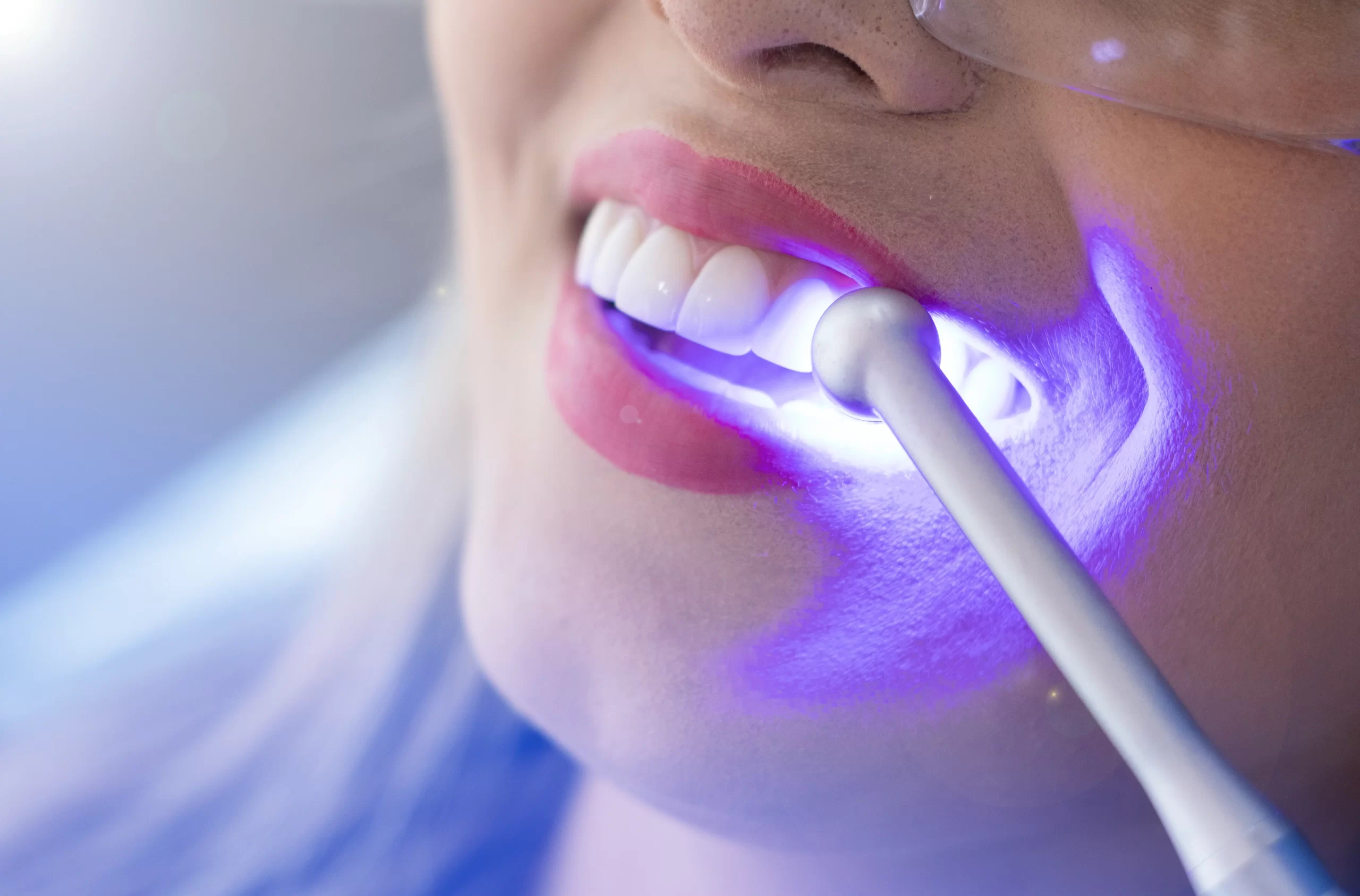 Blanqueamiento Dental: ¿Funciona Realmente y Es Seguro?